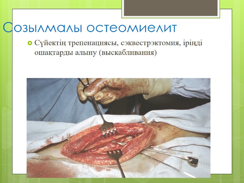 Созылмалы остеомиелит Сүйектің трепенациясы, сэквестрэктомия, іріңді ошақтарды алыну (выскабливания)